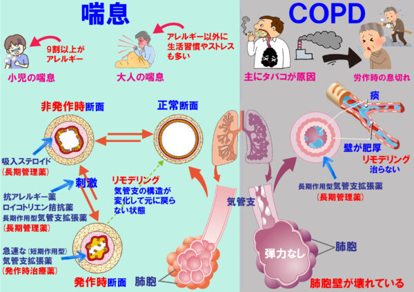 喘息とCOPDの違い